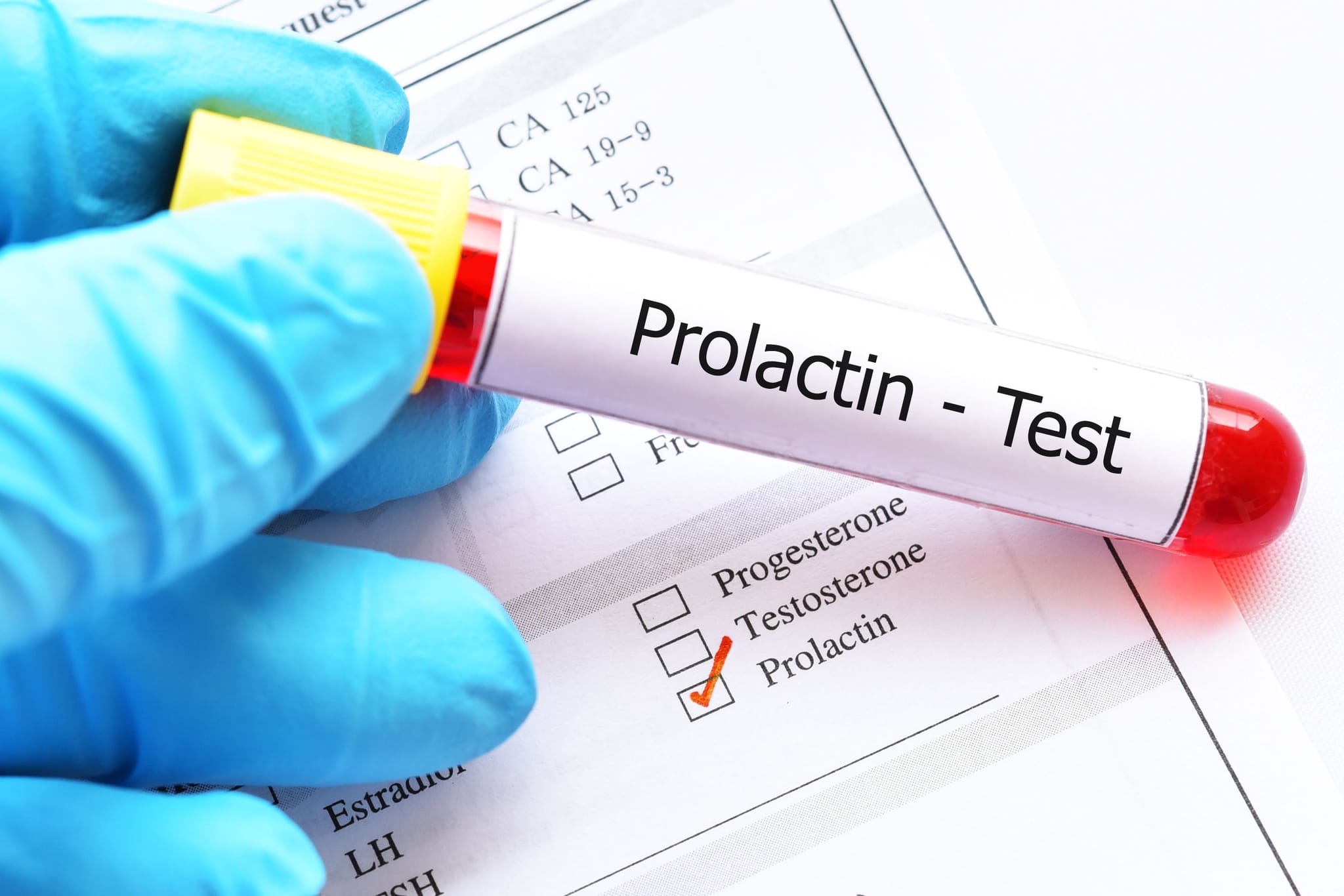Exame de prolactina: entenda sua função e como é realizado!