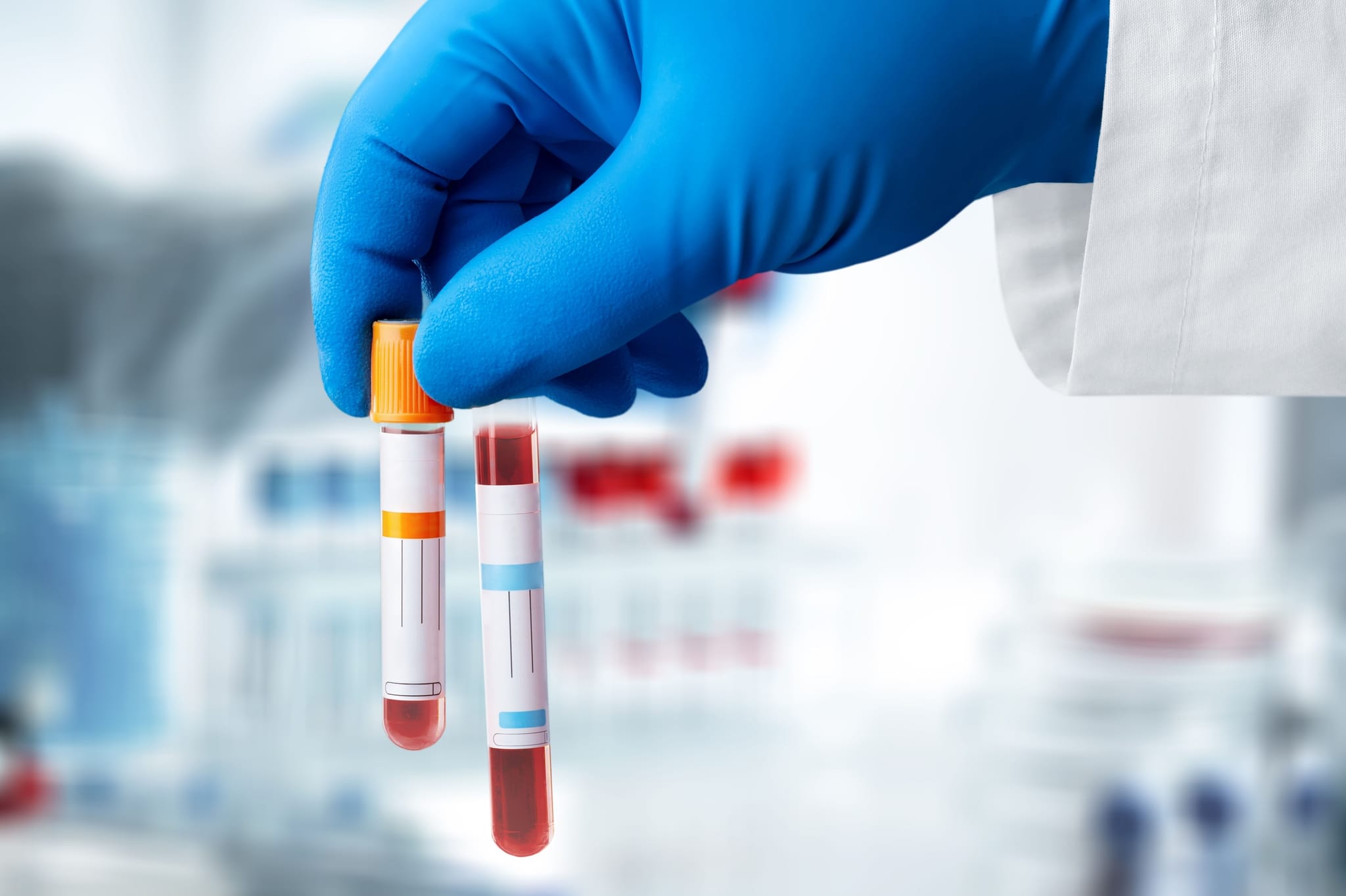Eletroforese de proteínas (soro): o que é o exame, para que serve e como é feito!